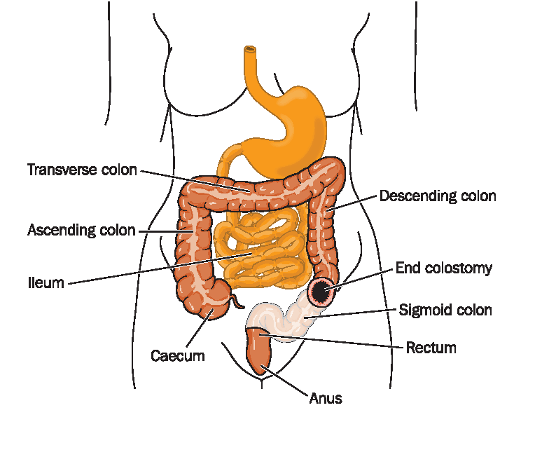 ileostomy and colostomy information